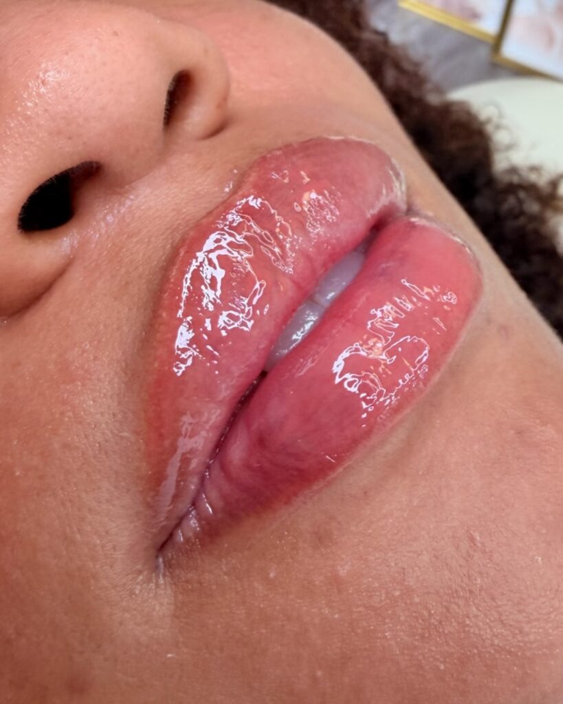 lip fillers bradon