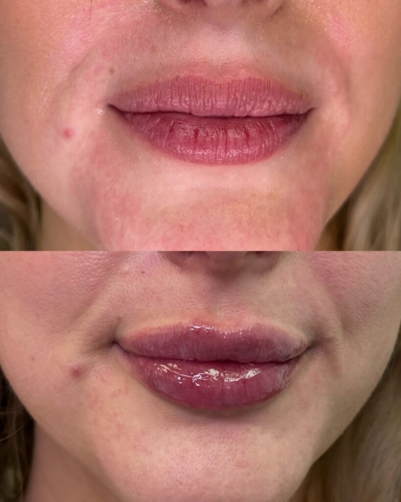 lip fillers mn
